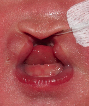 【美品】唇裂手術アトラス　ATLAS OF CLEFT LIP SURGERY Atlas of Operative Techniques in Primary Cleft Lip and